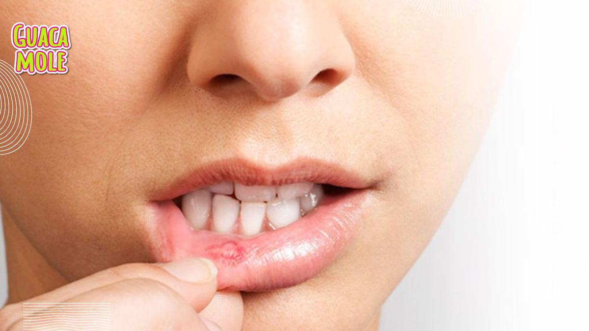 Úlceras bucales. | Te decimos las razones por las que te salen estas incómodas úlceras en la boca. (Especial: Clínica Dental Santa Pola).