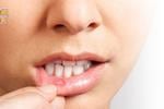 ¿Por qué nos salen úlceras en la boca?