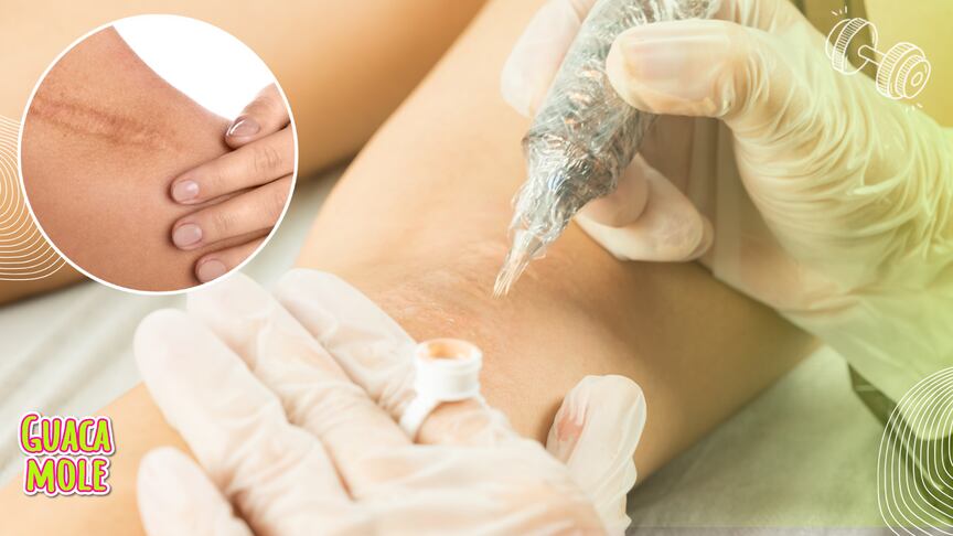 ¿Es posible tatuarse las cicatrices? Esto dice la UNAM. (Canva)